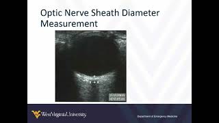 Ocular PointofCare Ultrasound 2  Abnormal Findings [upl. by Atsirc510]