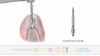 Astra Tech Implant System™ EV Guided surgery  Implant placement  Dentsply Sirona [upl. by Marteena]