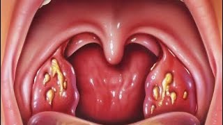 REMOVING TONSILS AND ADENOIDS [upl. by Vern984]