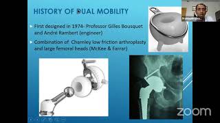 Which is better anterior or posterior approach for hip replacement [upl. by Beatrisa]