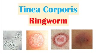 Ringworm Tinea Corporis  Causes Risk Factors Signs amp Symptoms Diagnosis and Treatment [upl. by Fiona]