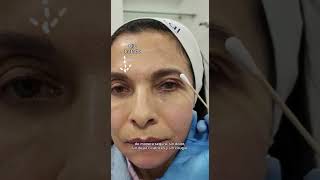 Blefaroplastia Sin Cirugía  Dr Angélica Domínguez Dermatóloga en bogotá [upl. by Blanch320]