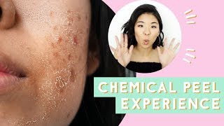 ✂ Chemical Peel for Acne amp Scars Before amp After [upl. by Phyl534]