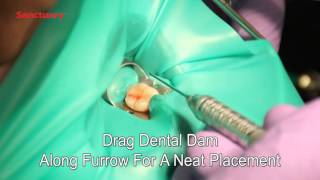 Placement of Sanctuary Dental Dam Clamps Premolar [upl. by Akissej186]