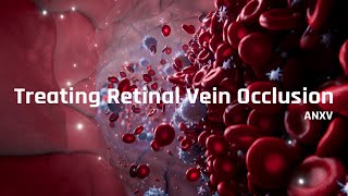 Treating Retinal Vein Occlusion RVO [upl. by Alla367]