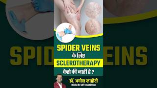 Treating Spider Veins with Sclerotherapy dramollahoti varicoseveins youtubeshorts [upl. by Lowry167]