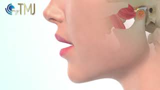 Jaw clicking TMJ disc displacement with reduction [upl. by Acillegna777]