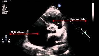 6B Parasternal short axis view of the left atrium and aorta Pulmonary Hypertension [upl. by Nomrac]