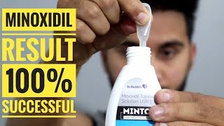 Grow Your Hair Using Minoxidil  100 Hair Regrowth Solution 🔥🔥🔥 [upl. by Oicnedurp]