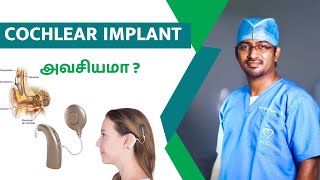 Cochlear Implant அவசியமா  Ear drum perforation in tamil  Dr Manoj ENT Speciality Centre  Trichy [upl. by Ecirad]