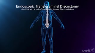 Endoscopic Transforaminal Approach for a Herniated Disc [upl. by Sullivan]