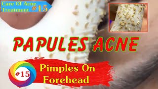 Removal Acne Papules Pimples On The Face  Care Of AcneTreatment 15 [upl. by Ettenor742]