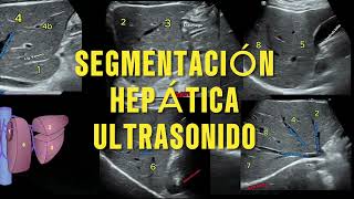 Domina la Segmentación Hepática con Ultrasonido Guía Rápida y Precisa de Couinaud [upl. by Aruon495]