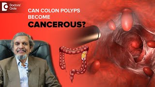 Colon Polyps  Risk of turning into Cancer amp Its Best Treatment Dr Rajasekhar M R Doctors Circle [upl. by Adalai]