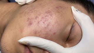 ACNE TREATMENT VU QUYNH MI Acne On Boys Chin 2024 [upl. by Artinahs354]