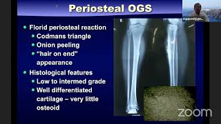 Osteosarcoma Current Concepts [upl. by Bartolome]