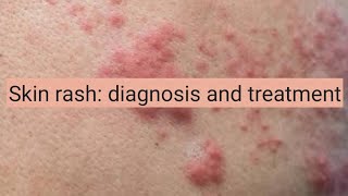 Skin Rash diagnosis and treatment [upl. by Ediva]