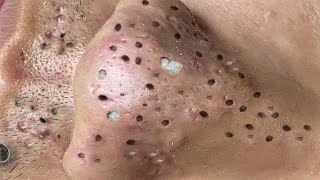 Blackhead Removal With Sac Dep Spa 1000341 [upl. by Enirehtacyram]