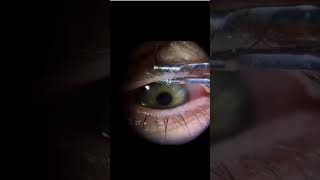 Meibomian gland expression shorts viral education optometrists ytshortsindia eye eyecare [upl. by Coryden]