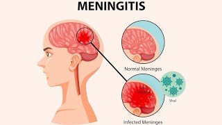 Meninges  Meningitis symptoms Diagnosis And Treatments [upl. by Hakaber539]