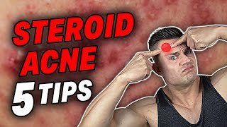 Got HORRIBLE Acne Or Bacne On Steroids Watch This [upl. by Lartnom]