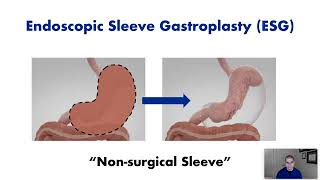 Endoscopic Sleeve Gastroplasty ESG  Procedure Overview [upl. by Sellihca]