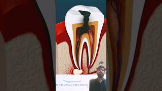 Root Canal Treatment amp Tooth Abscess shots [upl. by Sella]