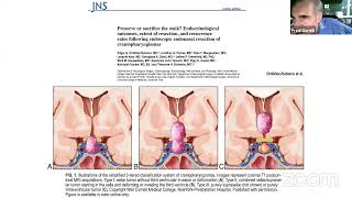 The Management Of Craniopharyngioma Open vs Endoscopic Techniques  Current State Of The Art [upl. by Roderica]