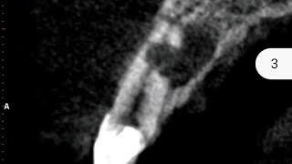 Non surgical management of Communicating resorption of 11 using MTA [upl. by Basham302]