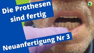 Neue Prothesen  Sprechprobe perfekter Saugeffekt Totalprothese Okklusion Remontage Tipps Tricks [upl. by Taffy]