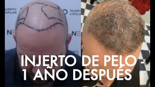 Te obligo a ver este video antes del injerto de pelo explicado por cirujano [upl. by Fesoj]