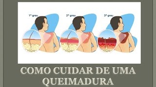 Como cuidar de uma queimadura [upl. by Scuram]