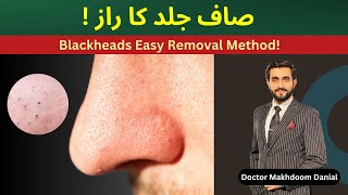 How to Remove Blackheads Permanently [upl. by Ardnoid]