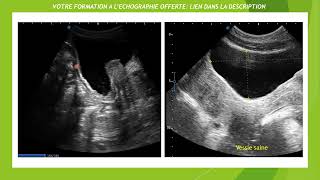 Découvrez laspect typique dune vessie de lutte en échographie  tout ce que vous devez savoir [upl. by Odracir104]