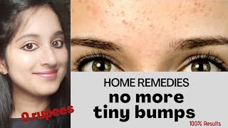 How to get rid of tiny bumps Naturally  Mathe par dano ka ilaj [upl. by Vanhook]