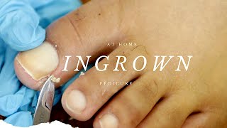 INGROWN TOENAIL PEDICURE AT HOME [upl. by Alikee]