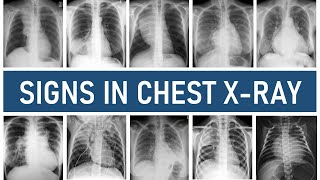 Signs in Chest Xray [upl. by Maitilde430]