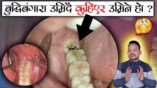 Wisdom Teeth decaybuddibangara kira le khako aauxaThird molar buddibangara pain relief in nepali [upl. by Freddi]