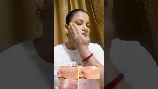 best home remedies for open pores ओपन पोर्स को मिटाने का घरेलू उपाय [upl. by Tarrah]