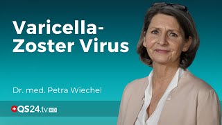 Windpocken amp Gürtelrose Gemeinsamkeiten und Schutzmassnahmen  Dr med Petra Wiechel  QS24 [upl. by Ahsaetan989]