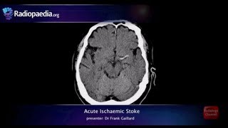 Stroke Acute infarction  radiology video tutorial CT MRI angiography [upl. by Amaleta570]