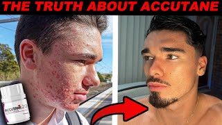 IS ACCUTANE WORTH IT  My Acne Journey [upl. by Yrbua]