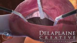 Robotic Atrial Septal Defect Repair [upl. by Kimber]