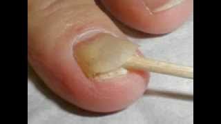 Nail psoriasis symptoms [upl. by Euhc]