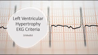 Left Ventricular Hypertrophy  EKG Criteria Sokolow  Lyon amp Cornell [upl. by Araes]