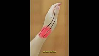 De Quervains Tenosynovitis Quick Fix in 5 Steps [upl. by Larrad]