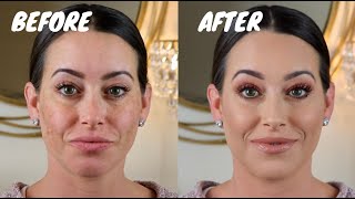 FULL COVERAGE MAKEUP FOR MELASMA amp HYPERPIGMENTATION pregnant foundation routine [upl. by Oine]