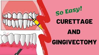 Techniques of Gingival Curettage [upl. by Ytomit]