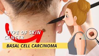 Basal cell carcinoma [upl. by Eeloj896]