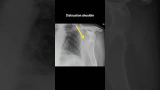 Dislocation shoulder xray radiology dislocation shoulder bahu [upl. by Allys828]